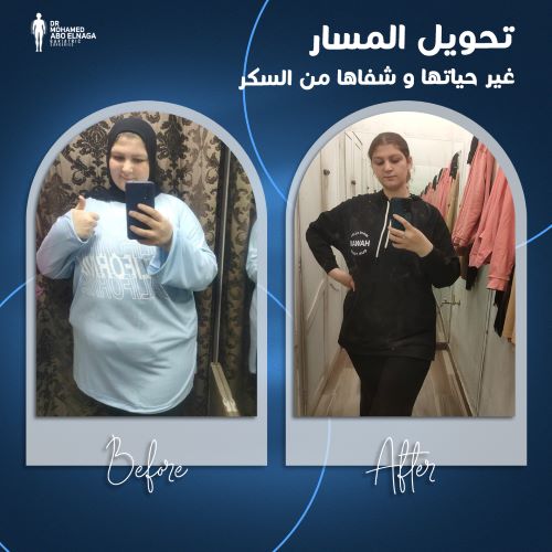  معدل نزول الوزن بعد عملية تحويل المسار